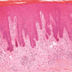 (A) Le psoriasis vulgaire est caractérisé par une acanthose, une parakératose et des infiltrats inflammatoires dermiques. 