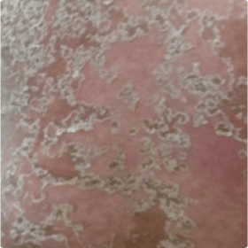 Lésions cutanées associées au PPG