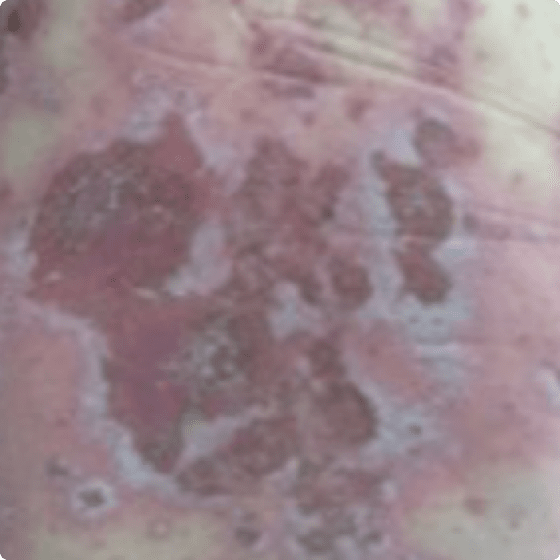 segment de peau illustrant une poussée de PPG